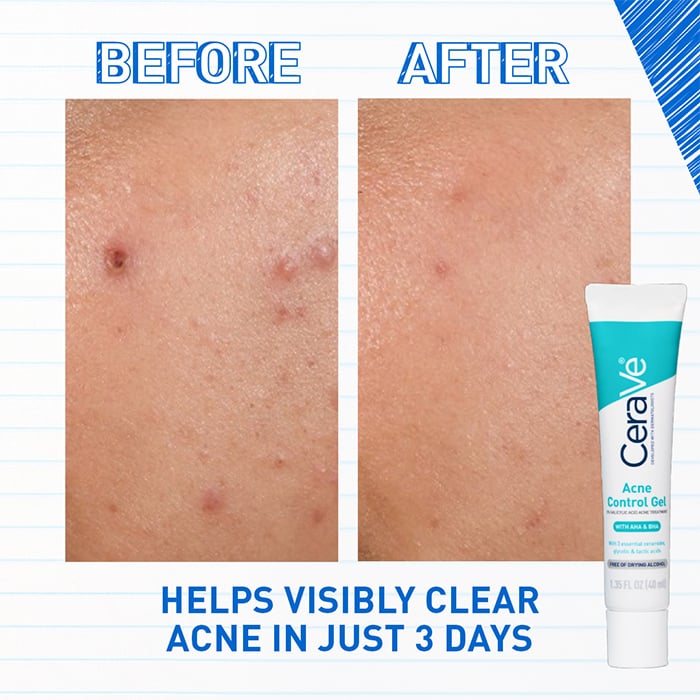 Acne Control Gel: Targeted Treatment - Image 3